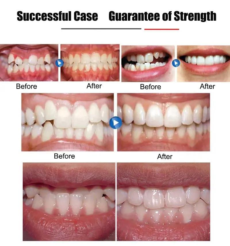 Invisible Braces Orthodontic Braces My Store