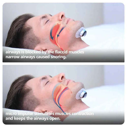 Smart Anti Snoring Device - Electronic Muscle Stimulator